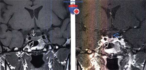 Микроаденома гипофиза на МРТ, гистология