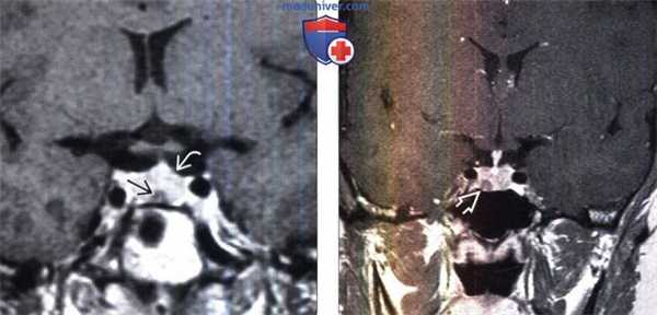 Микроаденома гипофиза на МРТ, гистология