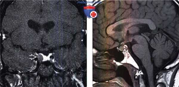 Микроаденома гипофиза на МРТ, гистология