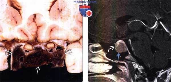 Апоплексия гипофиза на МРТ, макропрепарате