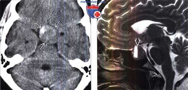 Апоплексия гипофиза на МРТ