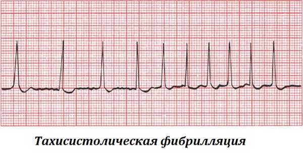 Методы лечения мерцательной аритмии