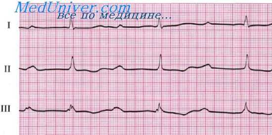 ЭКГ при аритмии