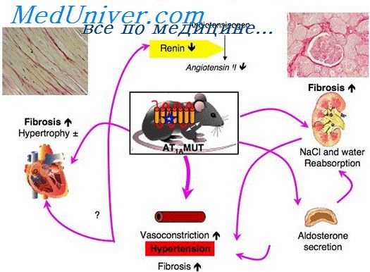 артериальная гипертония