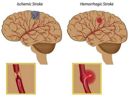 Ишемический и геморрагический инсульт