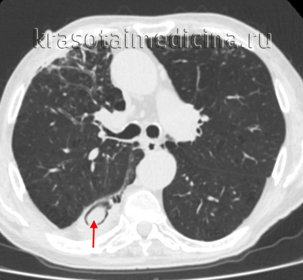 Аспергиллез легких