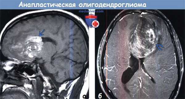 Анапластическая олигодендроглиома на МРТ