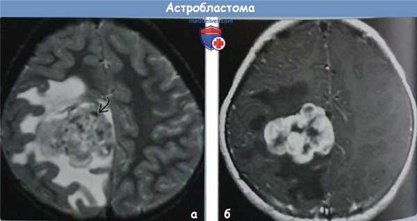 Астробластома на МРТ