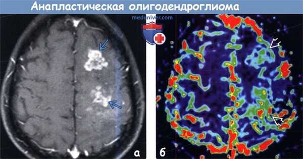 Анапластическая олигодендроглиома на МРТ