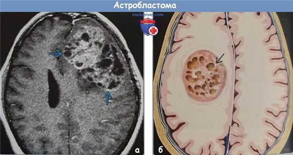 Астробластома на МРТ