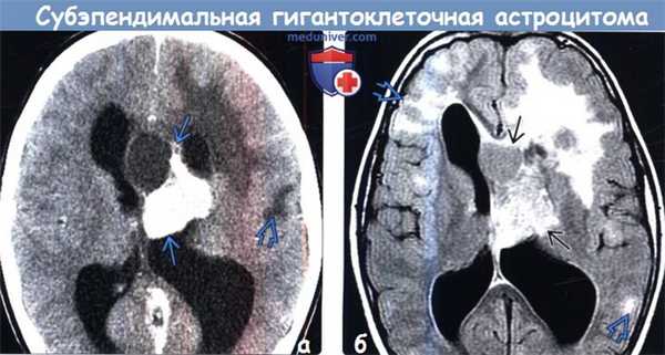 Субэпендимальная гигантоклеточная астроцитома на КТ, МРТ