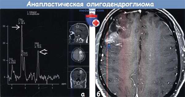 Анапластическая олигодендроглиома на МРТ