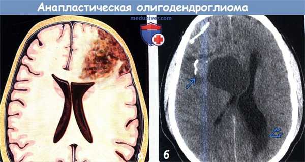 Анапластическая олигодендроглиома на КТ
