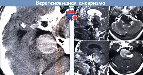 Атеросклеротическая веретеновидная аневризма головного мозга на КТ, МРТ