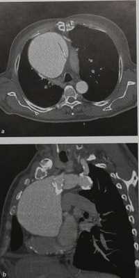 Снимки МРТ и КТ. Аневризма аорты средостение