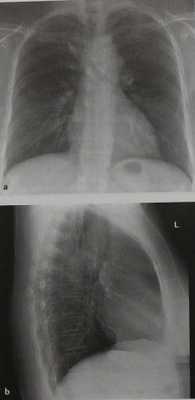 Снимки МРТ и КТ. Аневризма аорты средостение