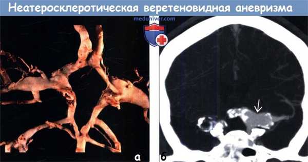Неатеросклеротическая веретеновидная аневризма головного мозга на КТ, ангиограмме