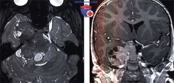 Атипичная и злокачественная менингиома на МРТ