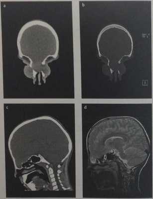 Снимки МРТ и КТ. Энцефалоцеле основания черепа