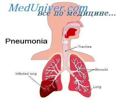 диагностика пневмонии
