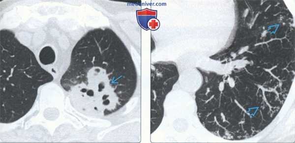 Бактериальная пневмония на КТ легких