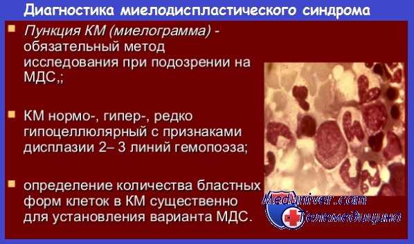 Диагностика миелодисплатического синдрома