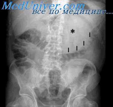 гипертрофия привратника