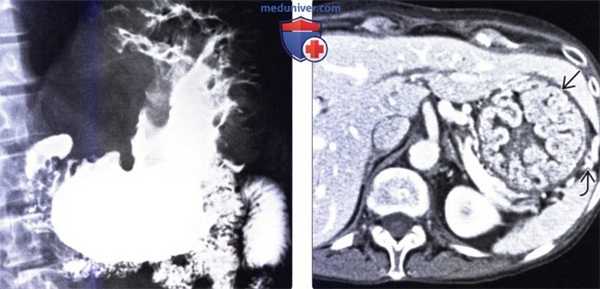 Лучевая диагностика болезни Менетрие