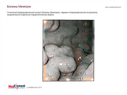 Болезнь Менетрие