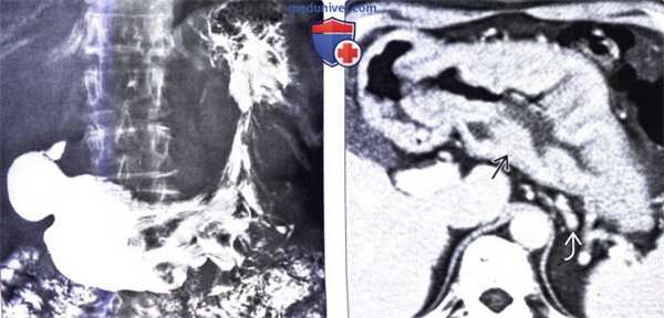 Лучевая диагностика болезни Менетрие
