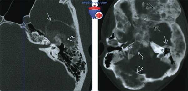 Фиброзная дисплазия височной кости - лучевая диагностика
