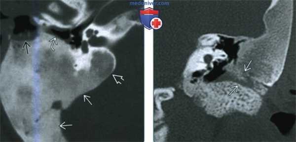 Фиброзная дисплазия височной кости - лучевая диагностика