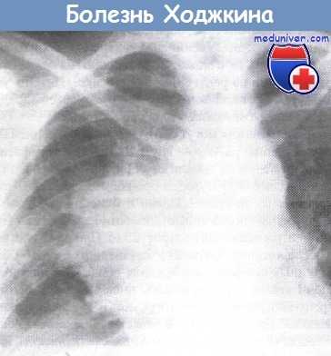 Болезнь Ходжкина