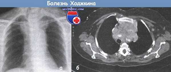 Болезнь Ходжкина