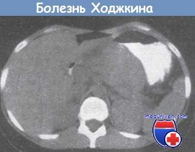 Болезнь Ходжкина