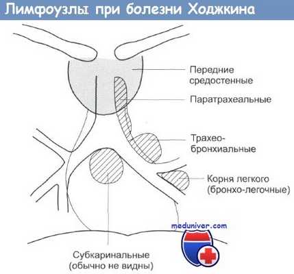 Лимфоузлы при болезни Ходжкина