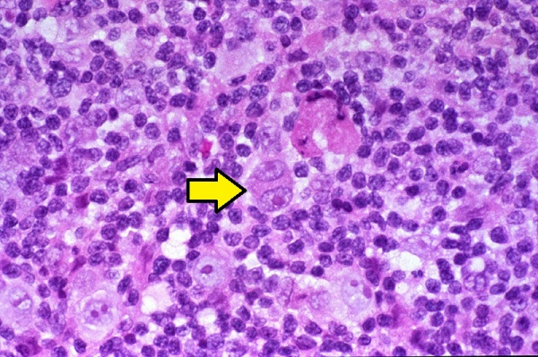 Клетки Березовского-Штернберга при лимфогранулематозе