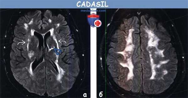 Церебральная аутосомно-доминантная артериопатия с субкортикальными инфарктами и лейкоэнцефалопатией (CADASIL) на МРТ