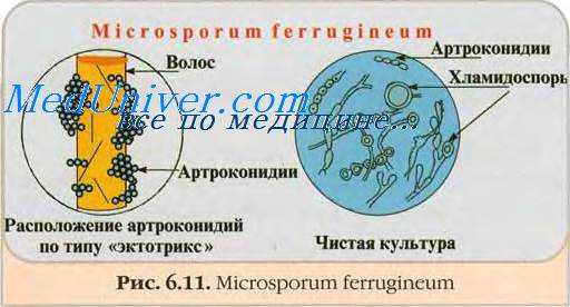 Клиника дерматомикозов. Симптомы дерматомикозов. Клиника эпидермафитий