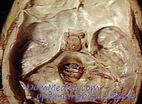 аденома гипофиза