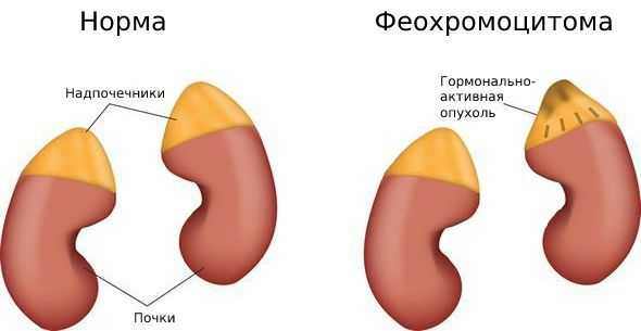 Феохромоцитома
