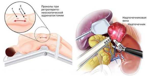 Ретроперитонеоскопия