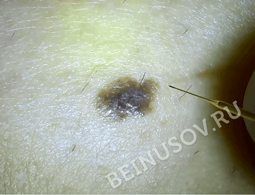 На фото - атипичный невус