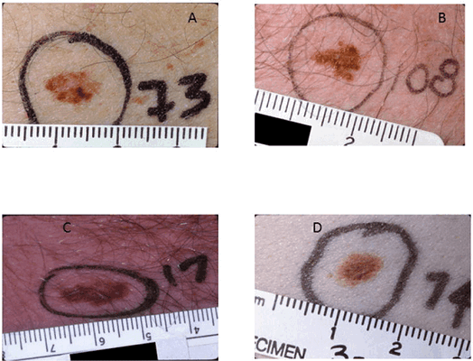 На фото - атипичные невусы