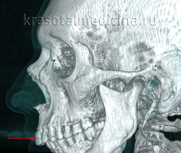 КТ черепа (3D-рендеринг). Прогнатический прикус, зубы верхней челюсти (красная стрелка) выстоят кпереди, отсутствует контакт резцовых краев при смыкании.