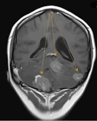 Метастазы в головном мозге