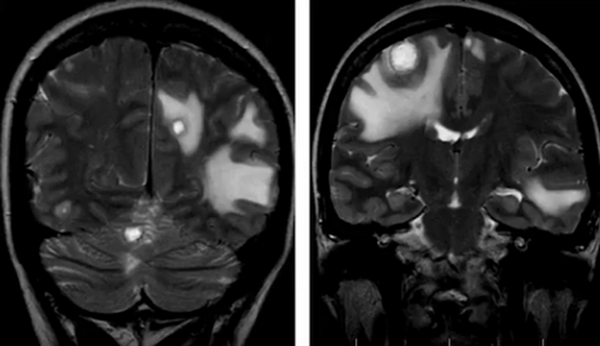Множественные метастазы в головном мозге