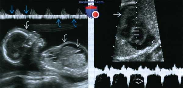 УЗИ при синдроме фето-фетальной трансфузии
