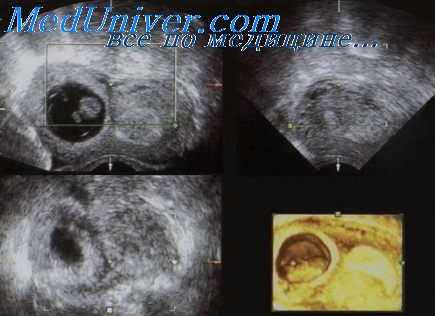 фето-фетальный синдром