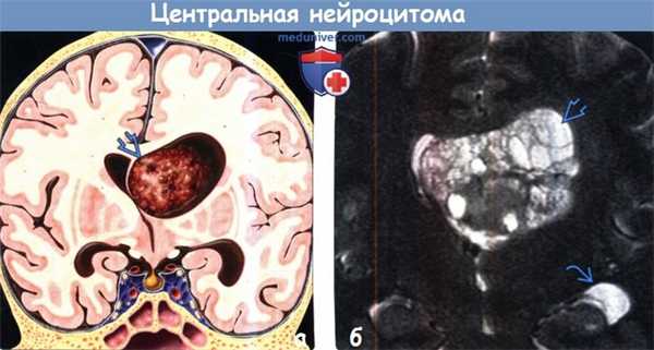 Центральная нейроцитома на МРТ